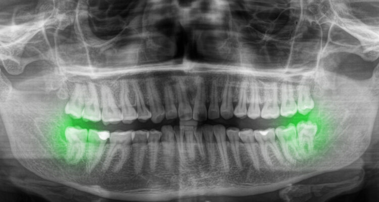 Видалення зубів мудрості. Часті питання
