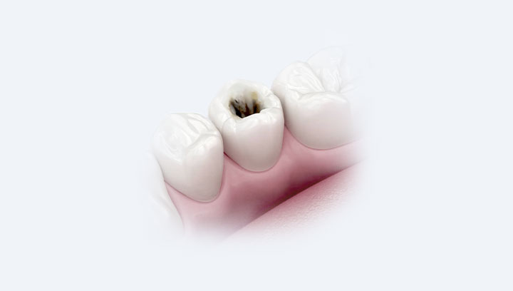 Лечение кариеса у детей