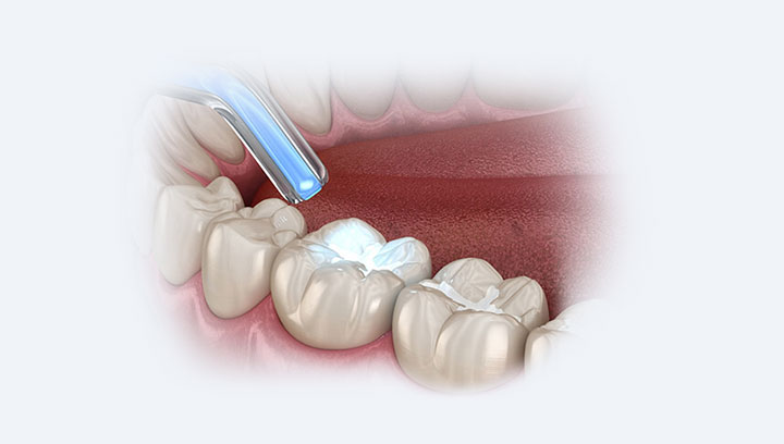 Лечение кариеса у детей