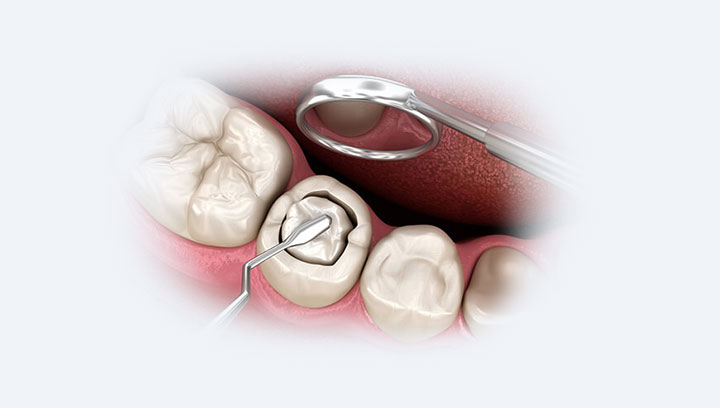 Лечение кариеса у детей