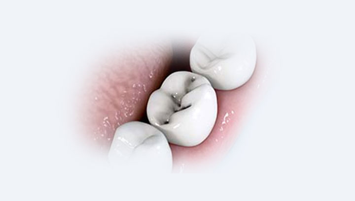 Лечение кариеса у детей