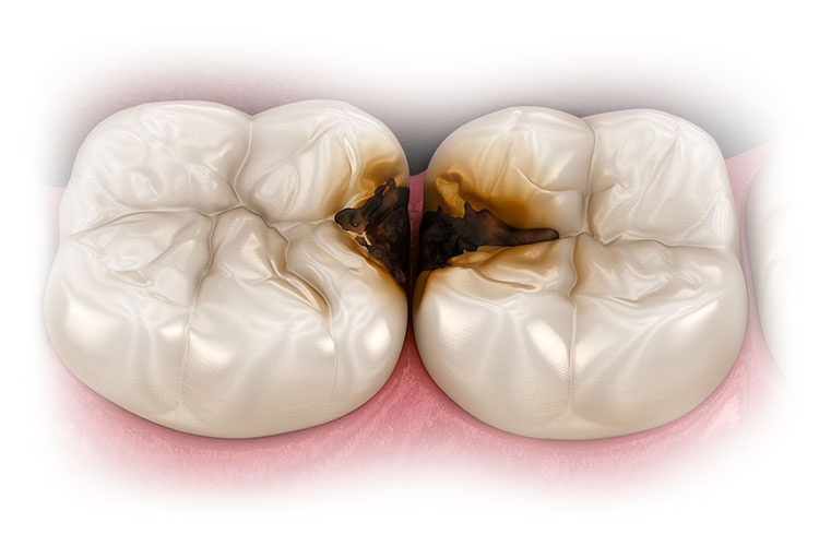 Лечение кариеса у детей