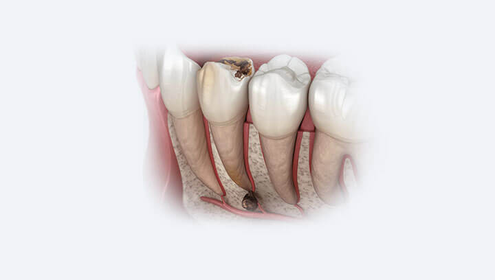 Зубний біль і його причини