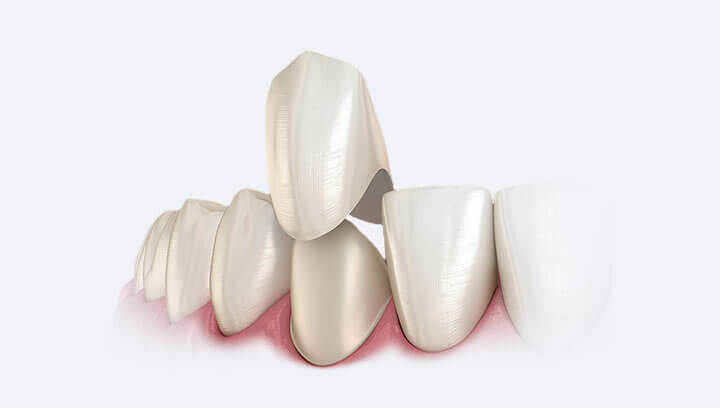 Дитячі зубні коронки