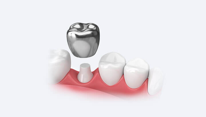 Дитячі зубні коронки