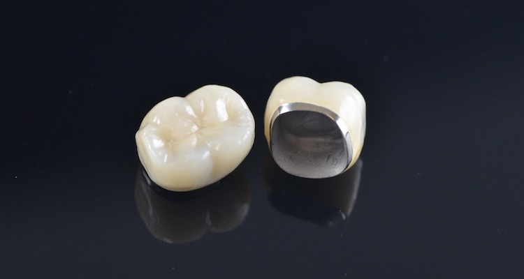 Металокерамічні коронки