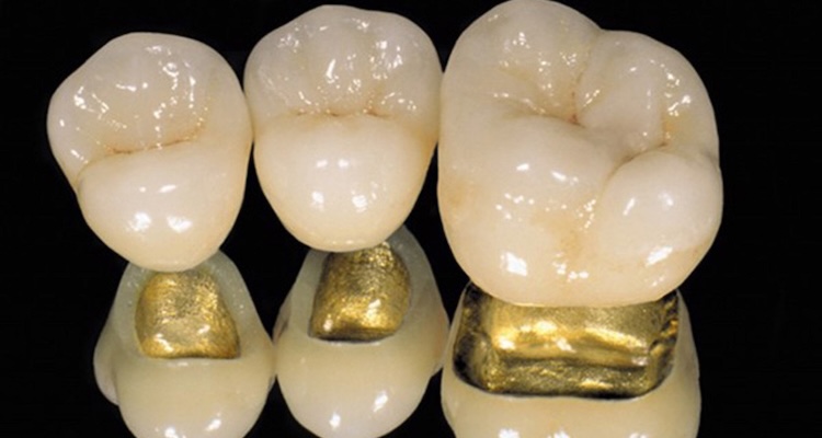 Металокерамічні коронки