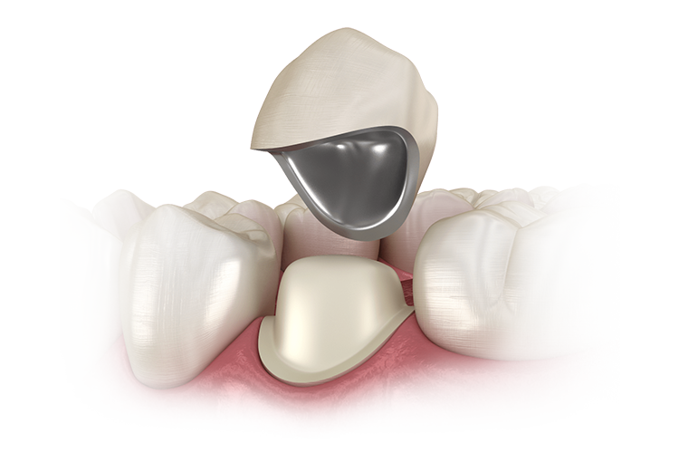 Металокерамічні коронки