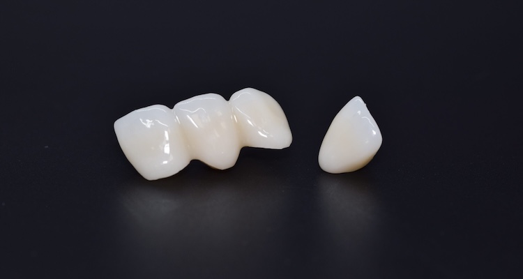 Металокерамічні коронки