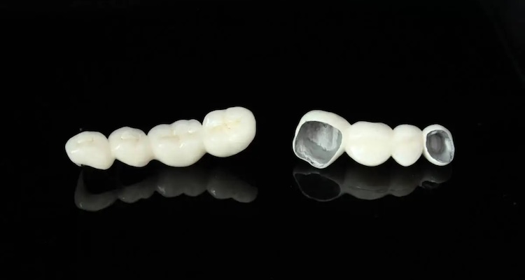 Металокерамічні коронки