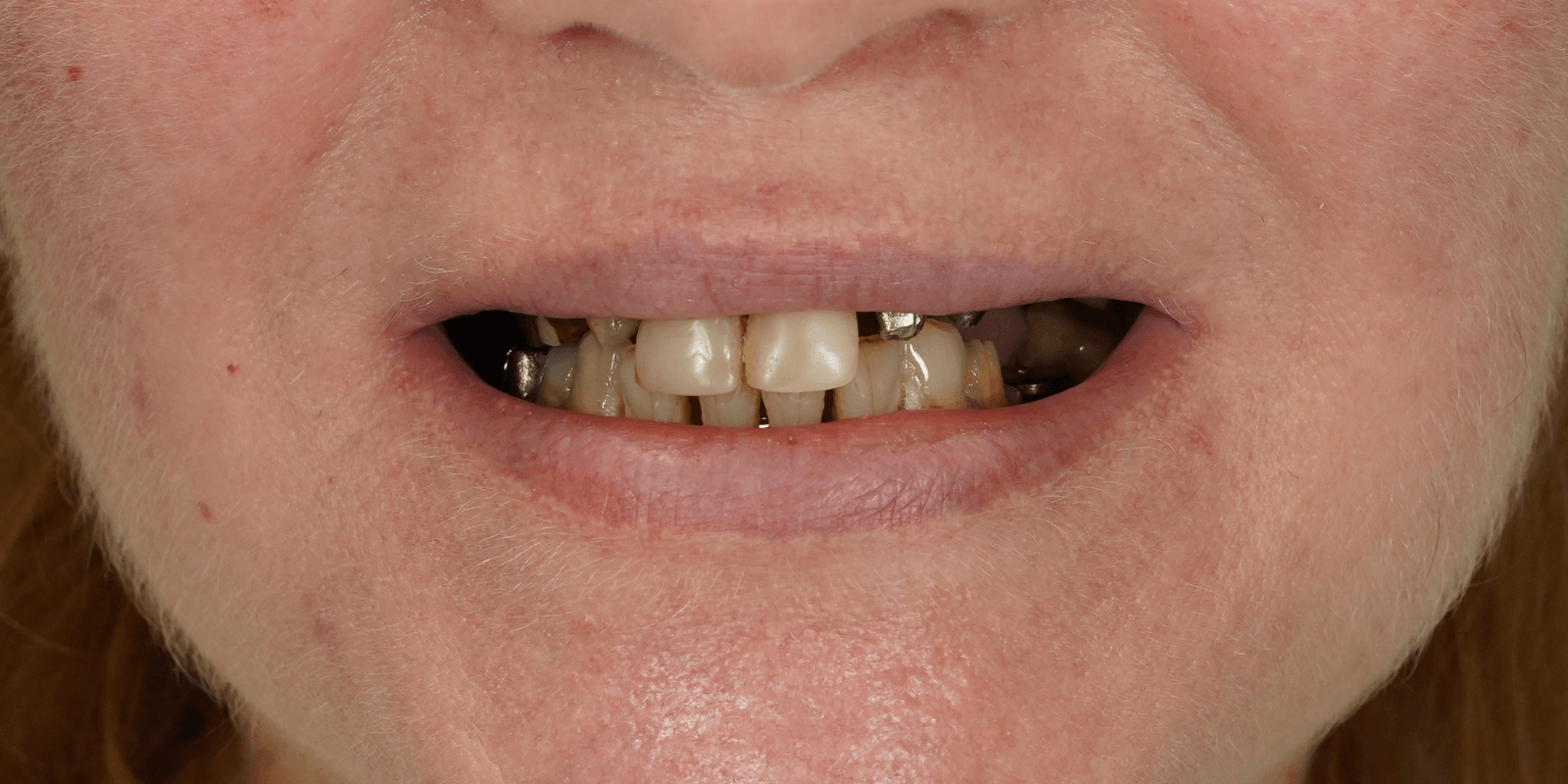 Імплантація та протезування коронками з діоксиду цирконію