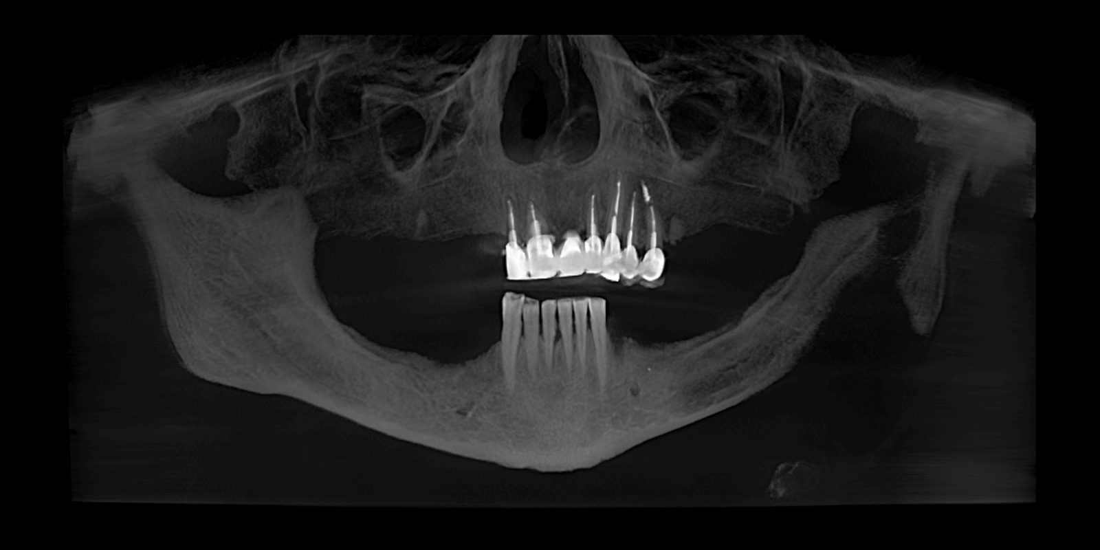 Замінили старі мости на імпланти та коронки з діоксиду цирконію