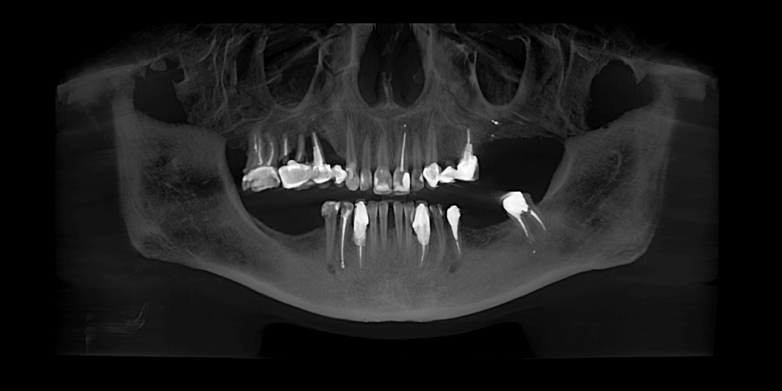 Імплантація та протезування "цирконієвими" коронками