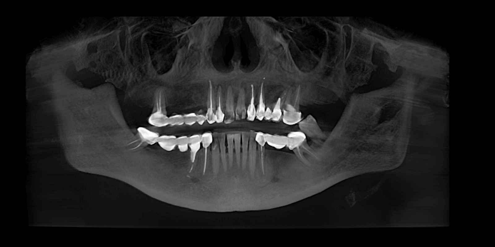 Імплантація та протезування коронками з діоксиду цирконію