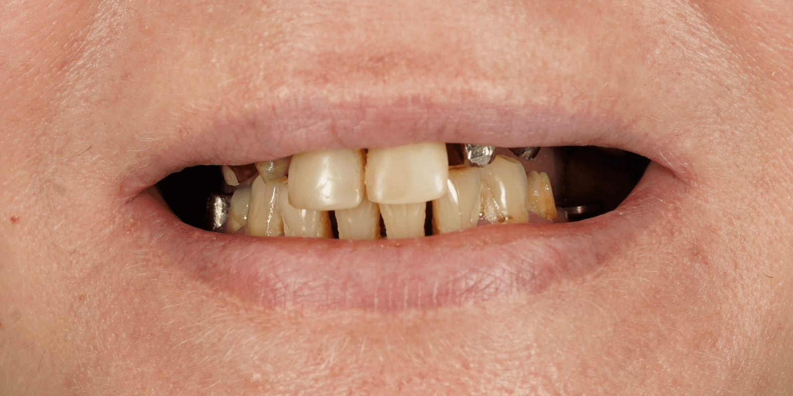 Імплантація та протезування коронками з діоксиду цирконію