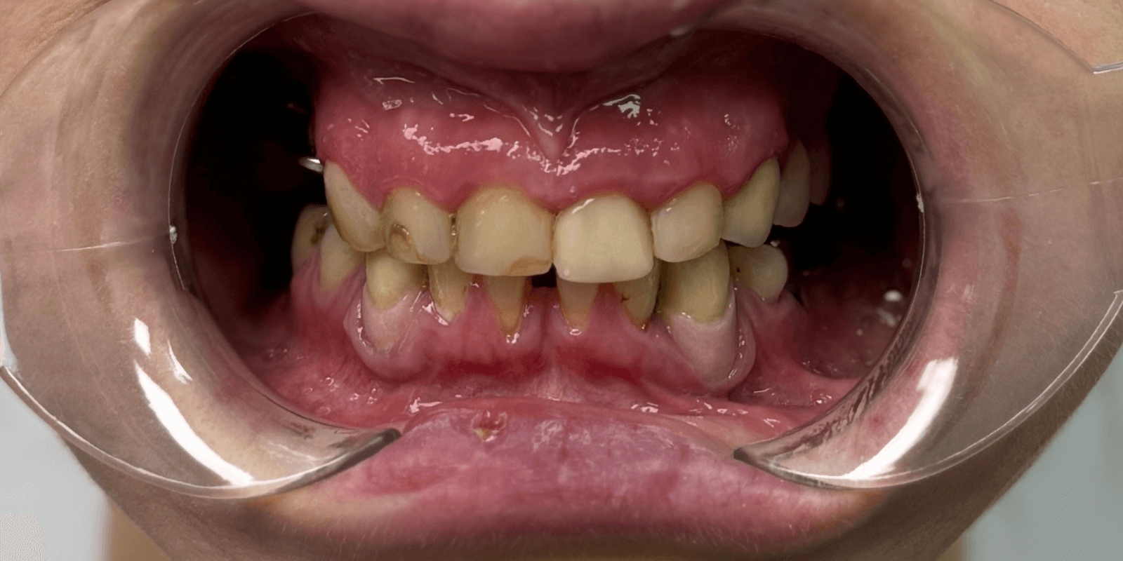 Імплантація та протезування "цирконієвими" коронками