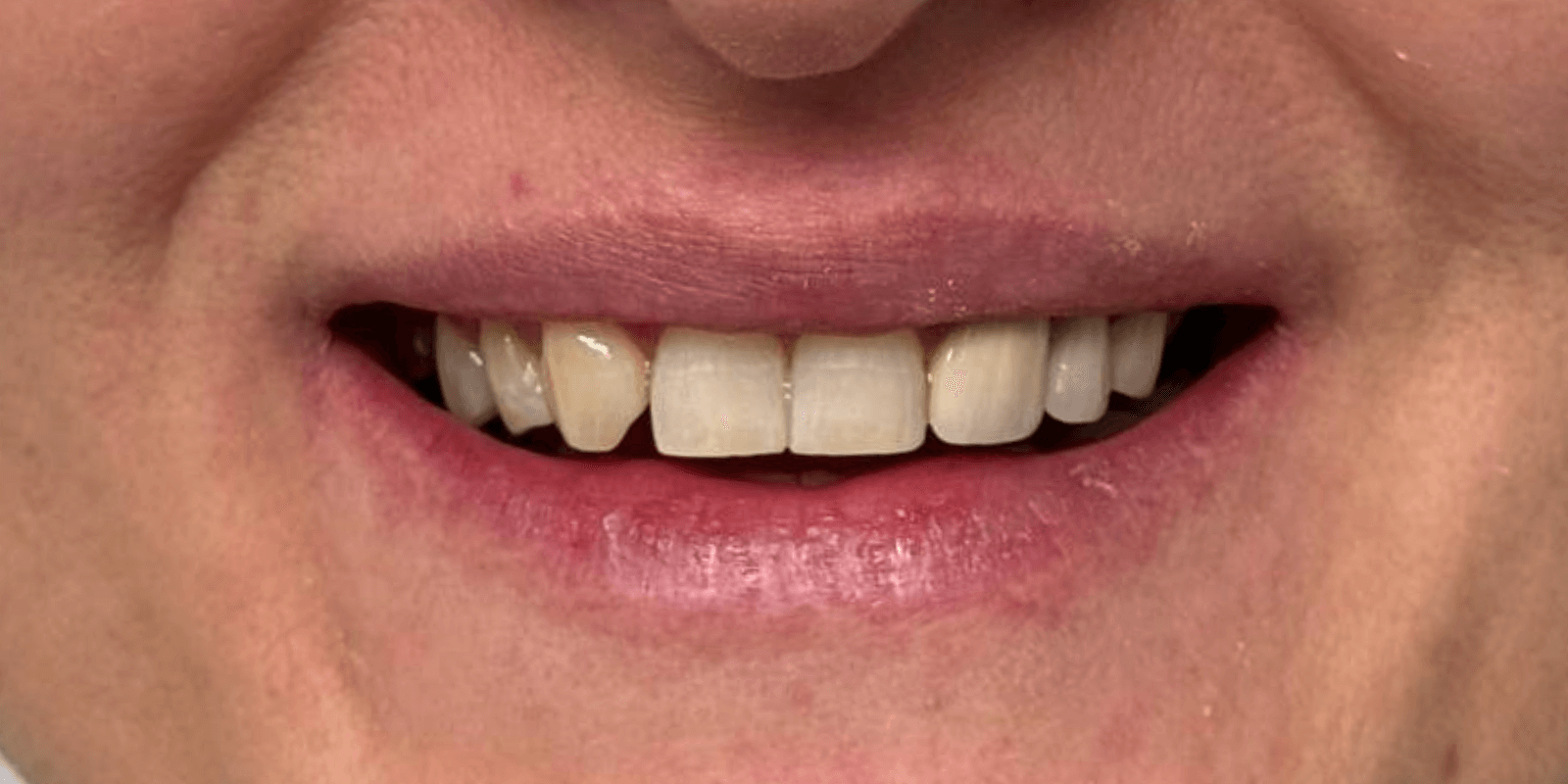 Імпланти Nobel та коронки e.max - неперевершений результат