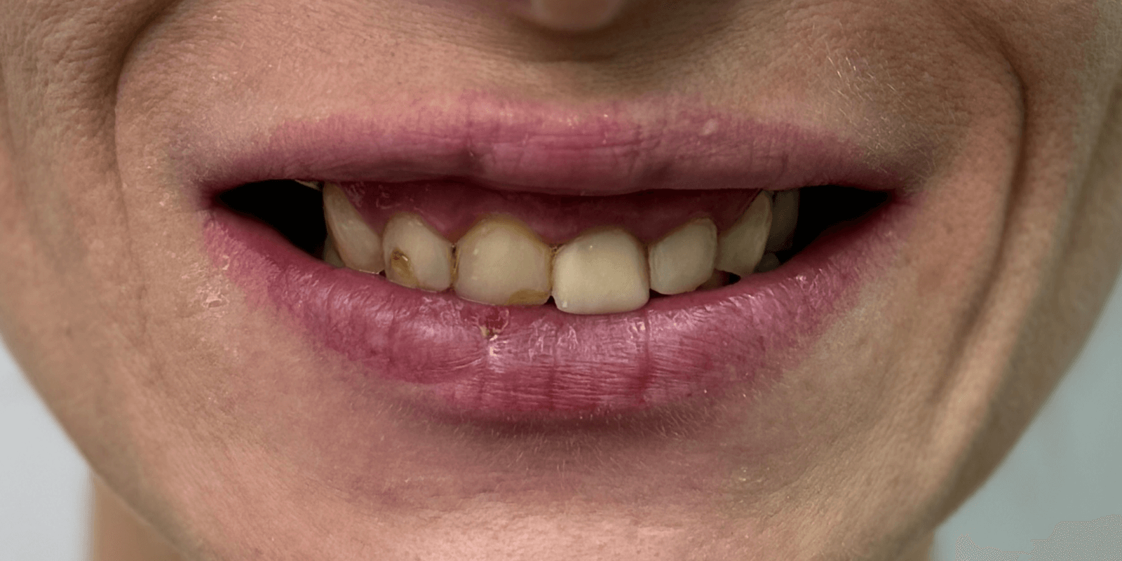 Імплантація та протезування "цирконієвими" коронками