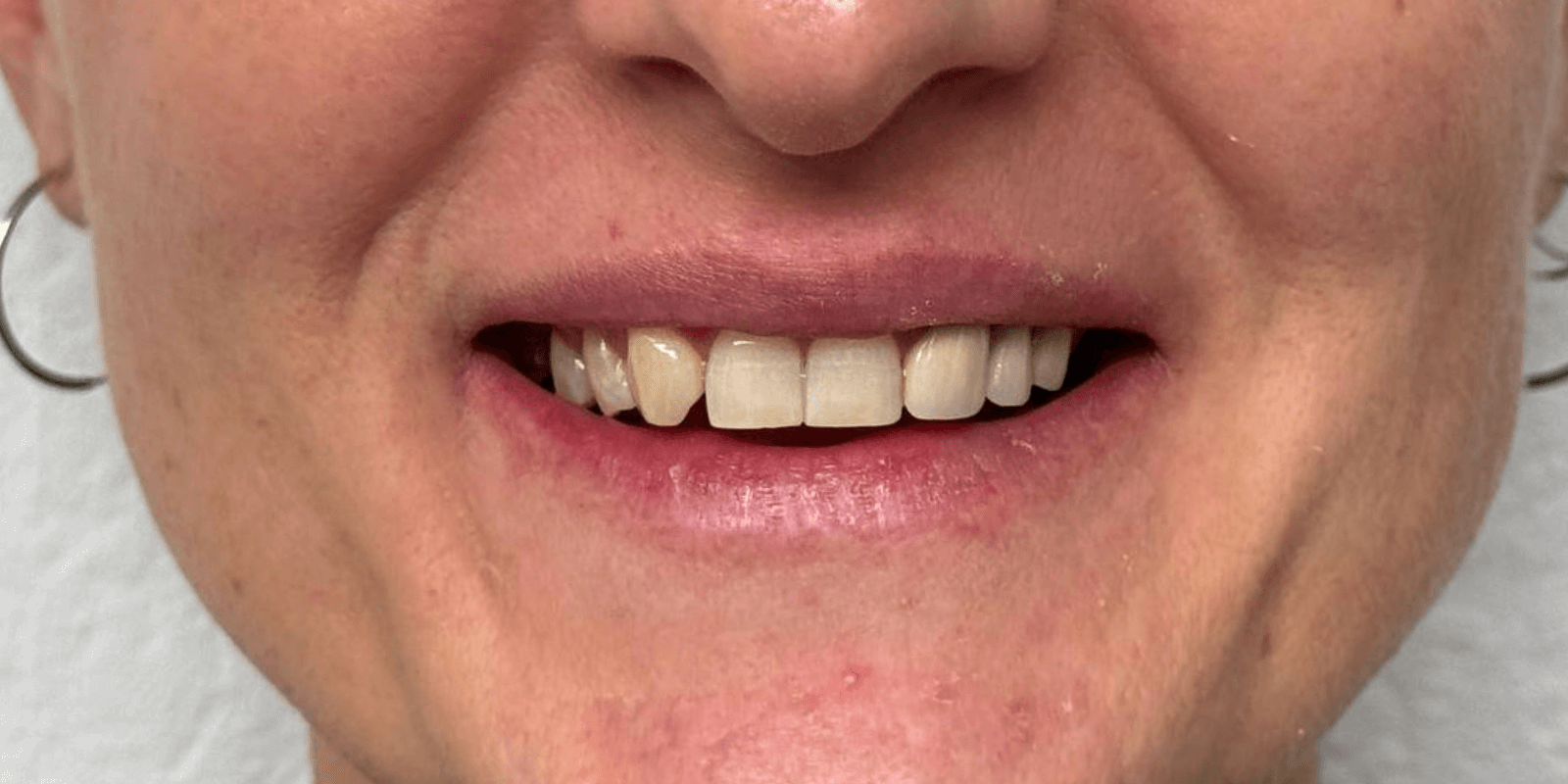 Імпланти Nobel та коронки e.max - неперевершений результат