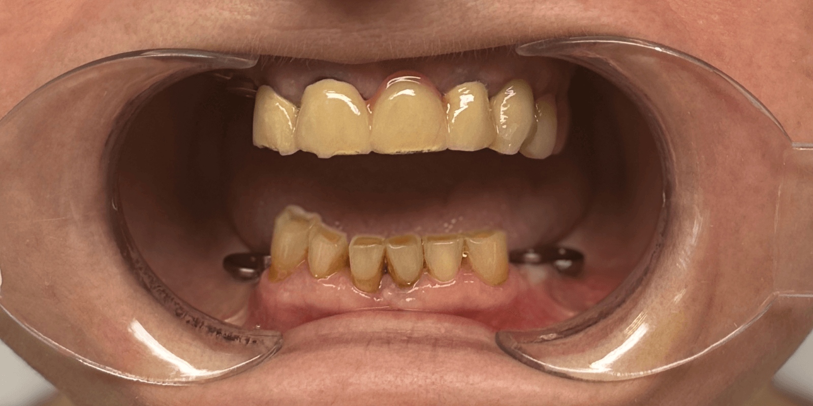 Замінили старі мости на імпланти та коронки з діоксиду цирконію