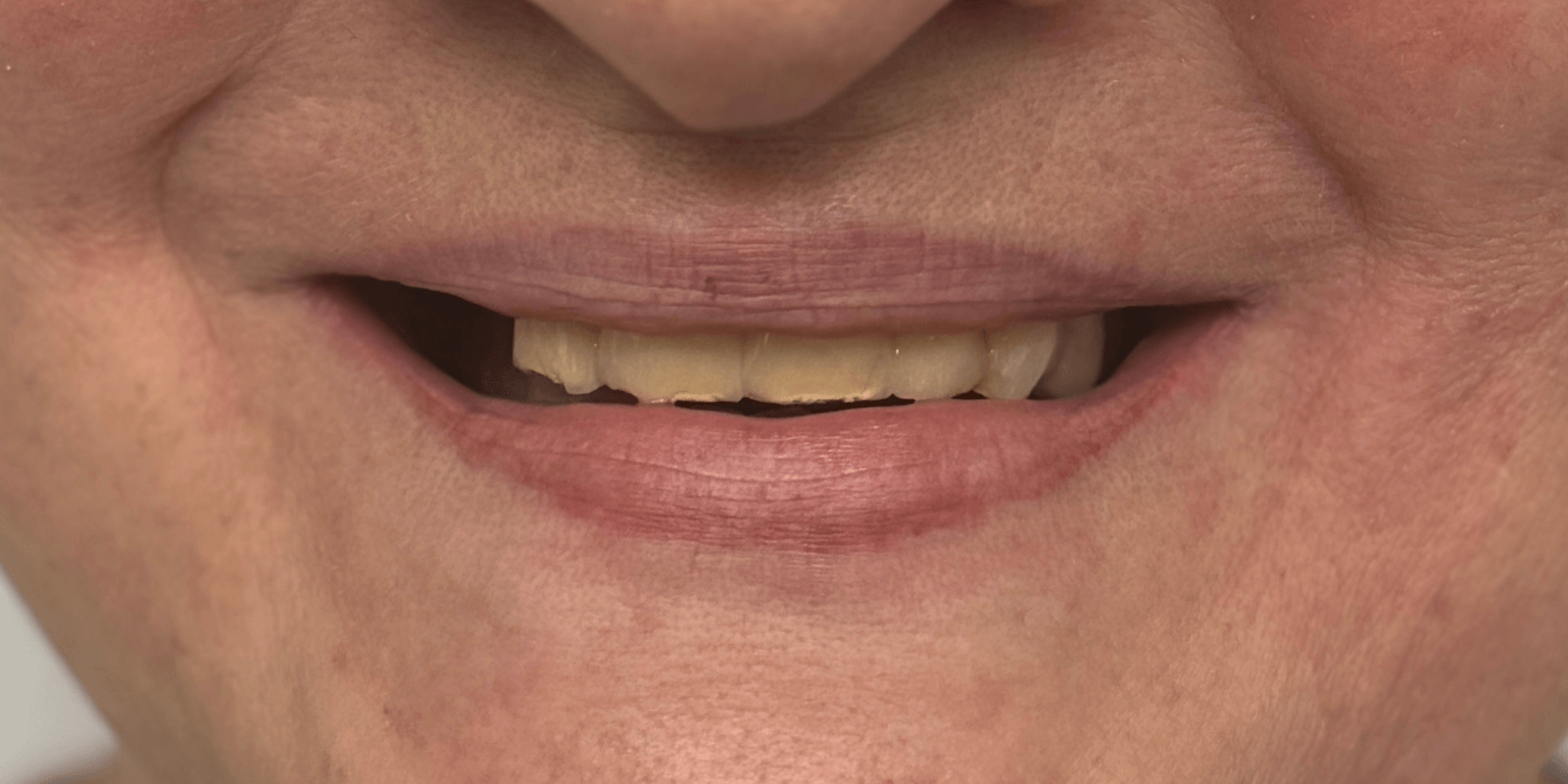 Замінили старі мости на імпланти та коронки з діоксиду цирконію