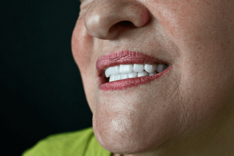 Замінили старі мости на імпланти та коронки з діоксиду цирконію