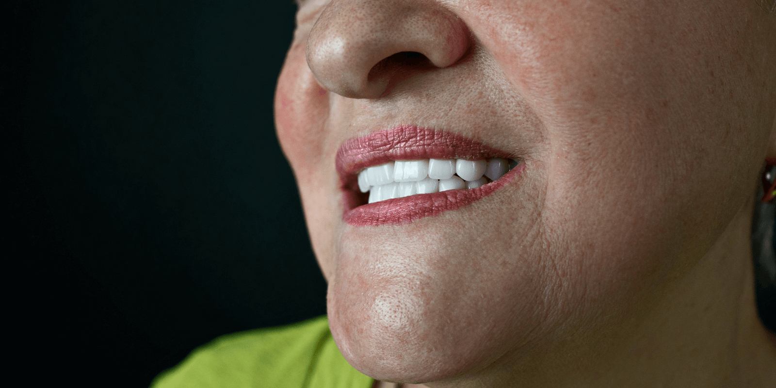 Замінили старі мости на імпланти та коронки з діоксиду цирконію