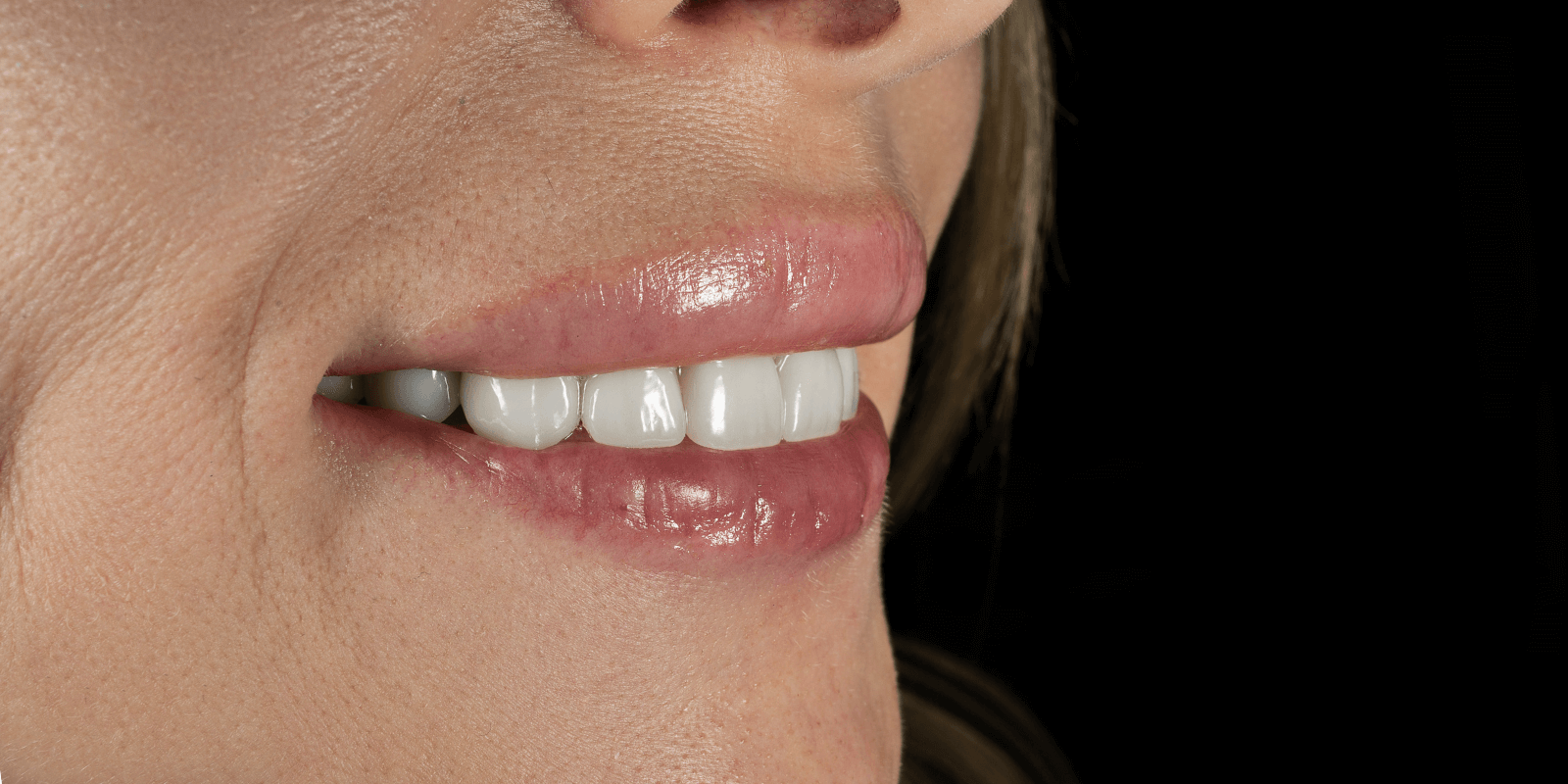 Імплантація та протезування "цирконієвими" коронками