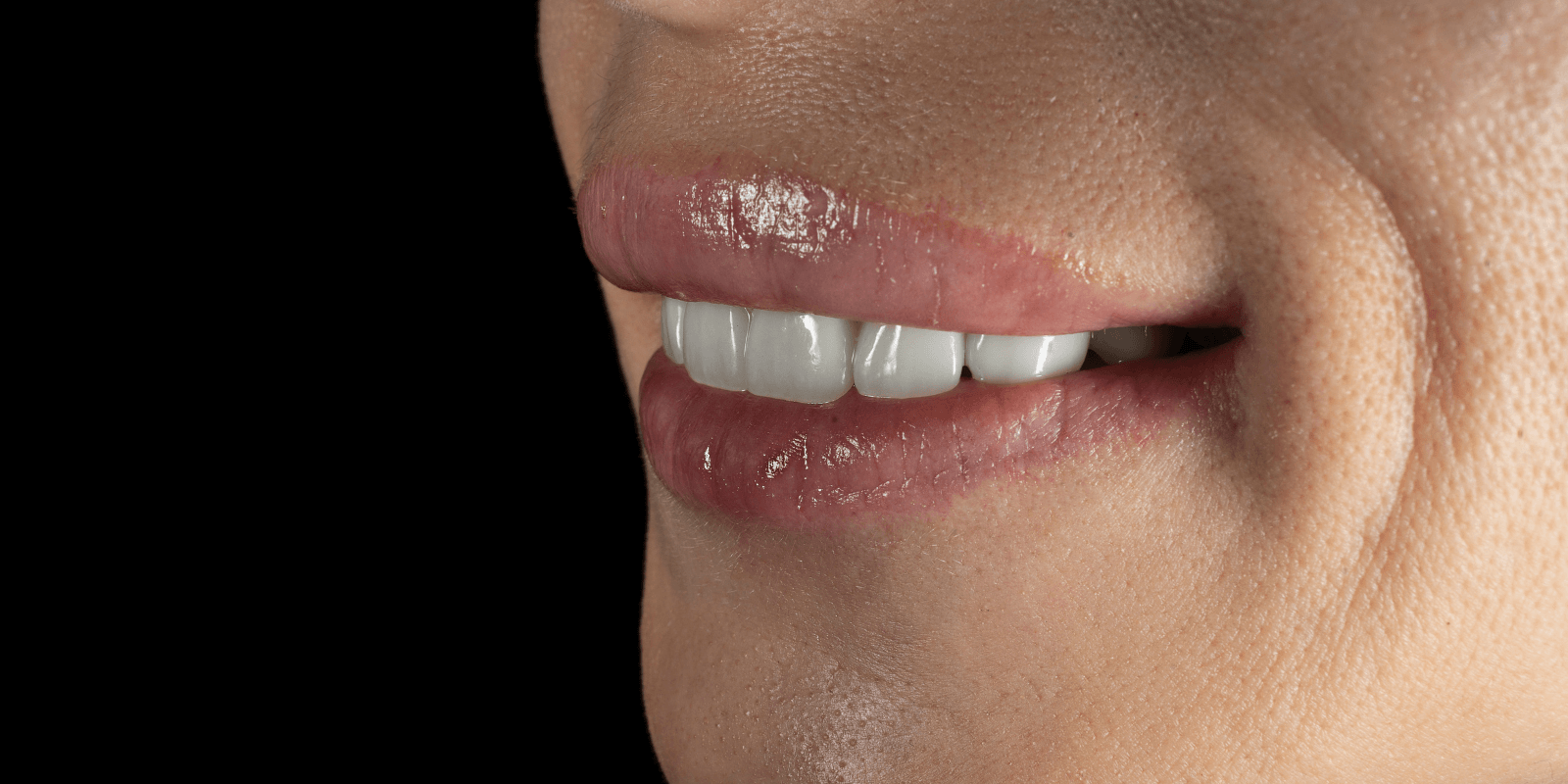 Імплантація та протезування "цирконієвими" коронками