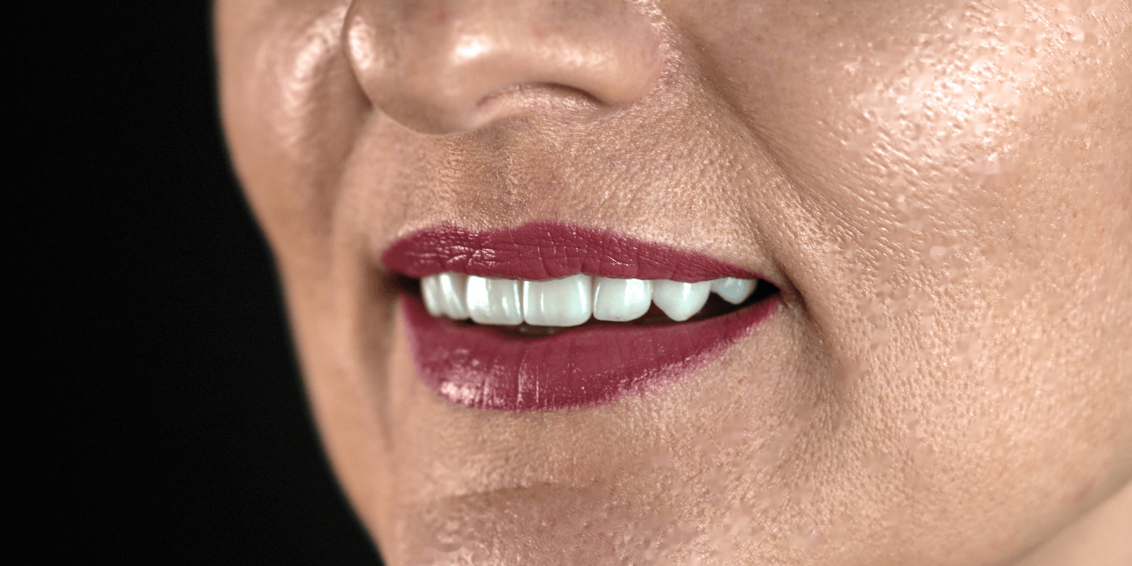 Імпланти Nobel та коронки e.max - неперевершений результат