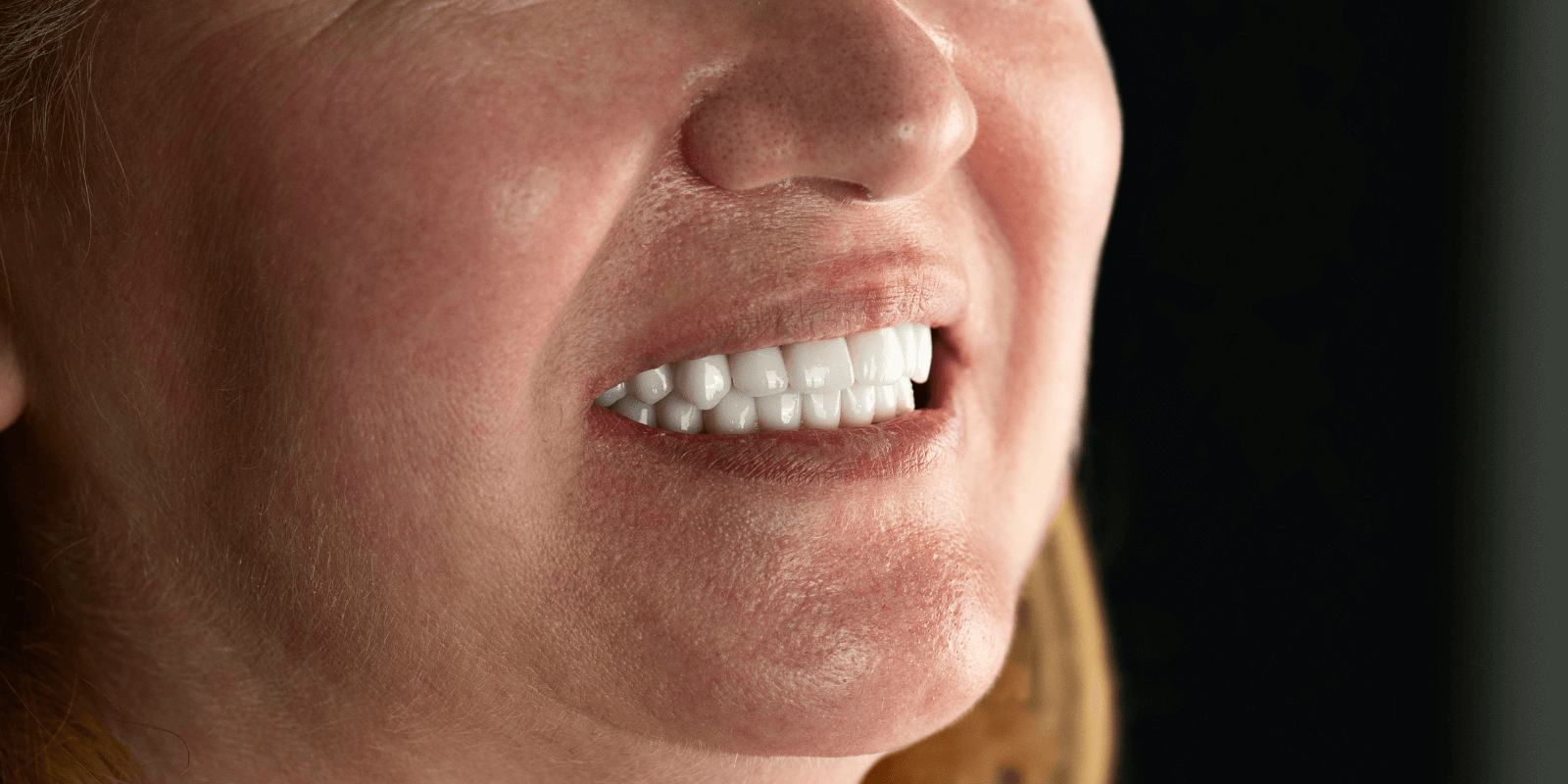 Імплантація та протезування коронками з діоксиду цирконію