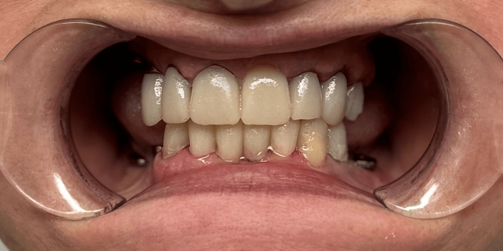 Замінили старі мости на імпланти та коронки з діоксиду цирконію