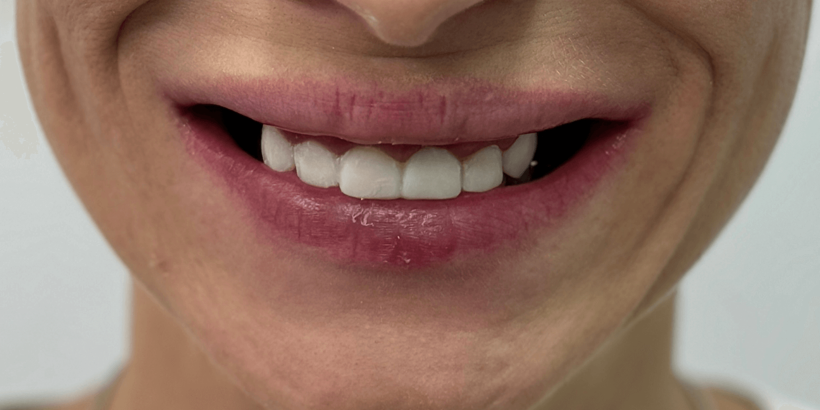 Імплантація та протезування "цирконієвими" коронками