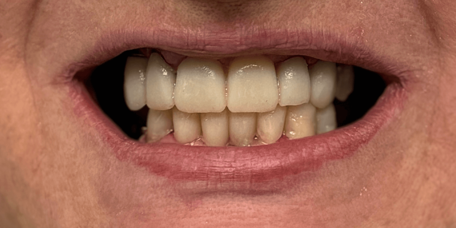 Замінили старі мости на імпланти та коронки з діоксиду цирконію