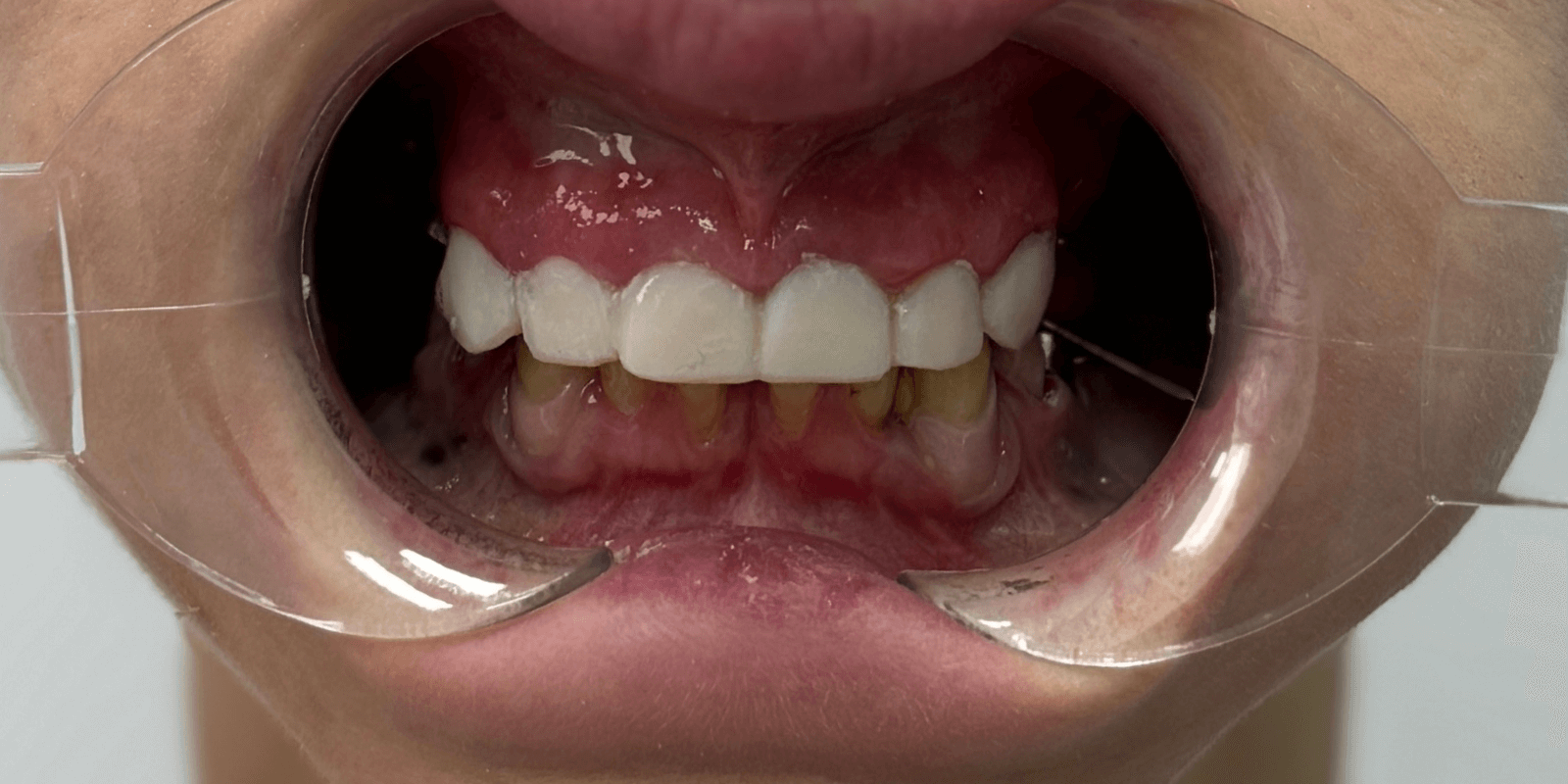 Імплантація та протезування "цирконієвими" коронками