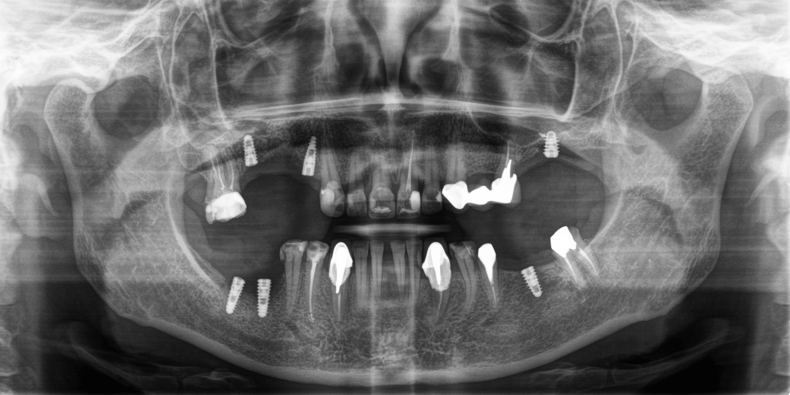 Імплантація та протезування "цирконієвими" коронками