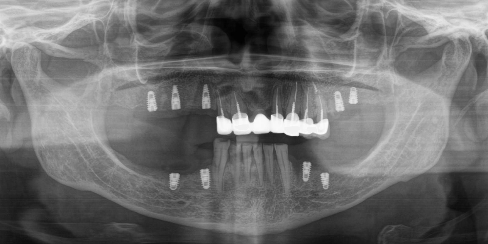Замінили старі мости на імпланти та коронки з діоксиду цирконію