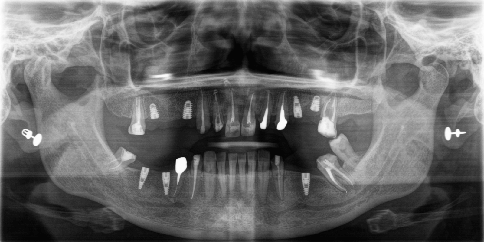Імплантація та протезування коронками з діоксиду цирконію