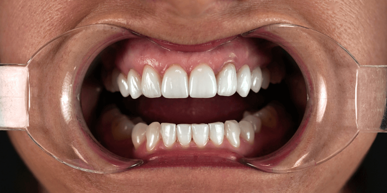 Імпланти Nobel та коронки e.max - неперевершений результат