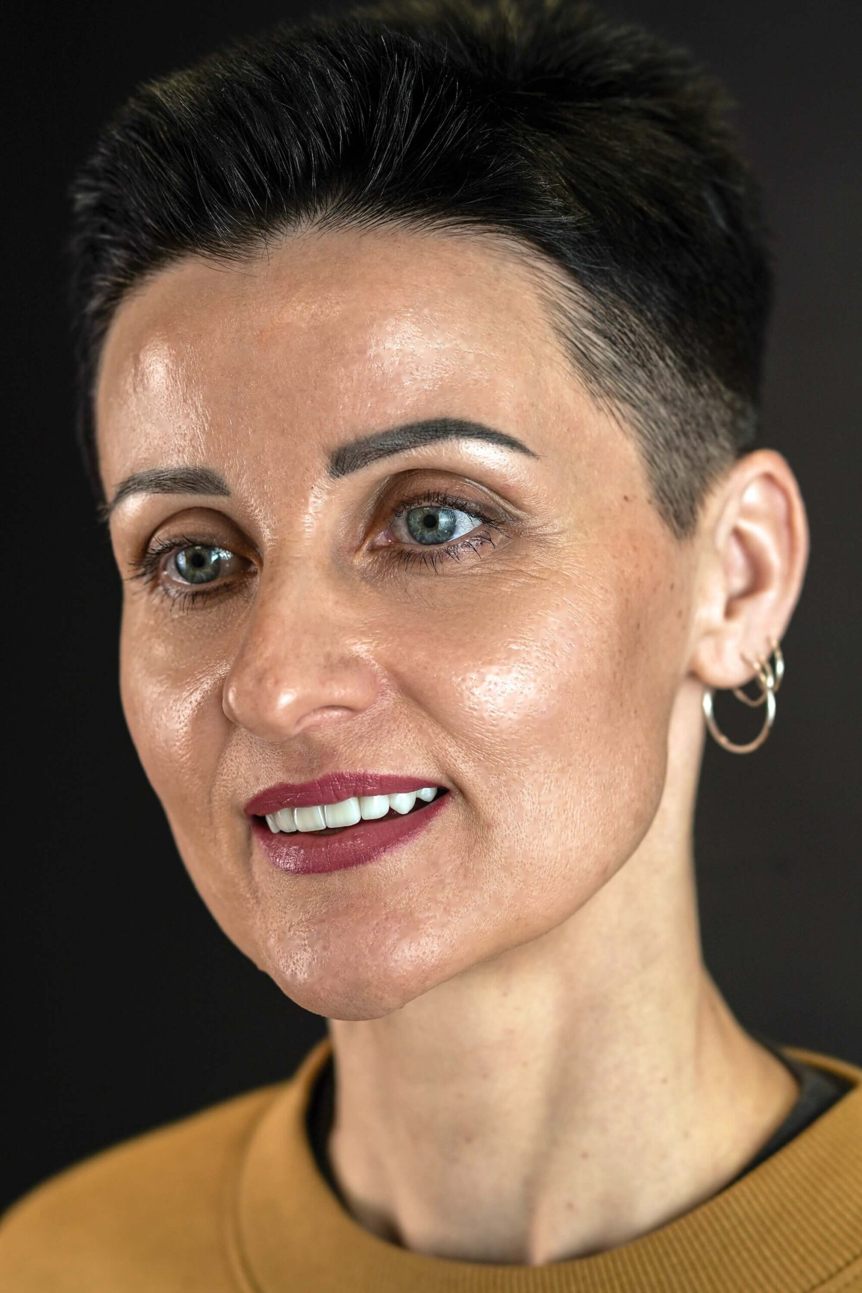 Імпланти Nobel та коронки e.max - неперевершений результат