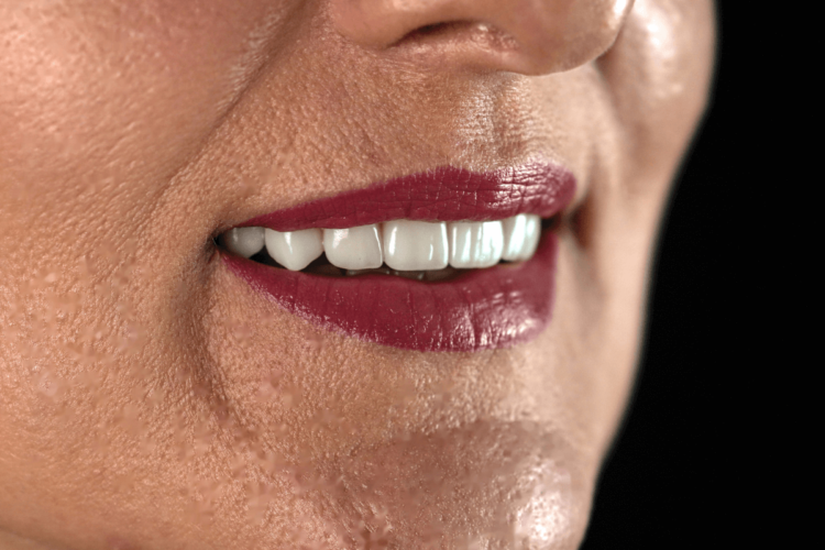 Імпланти Nobel та коронки e.max - неперевершений результат