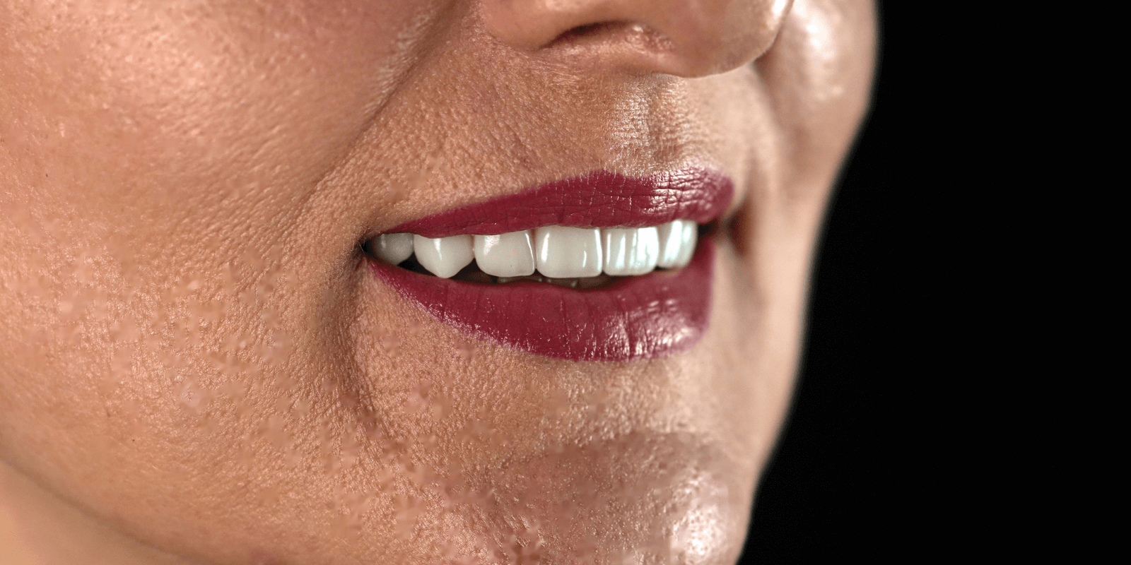 Імпланти Nobel та коронки e.max - неперевершений результат