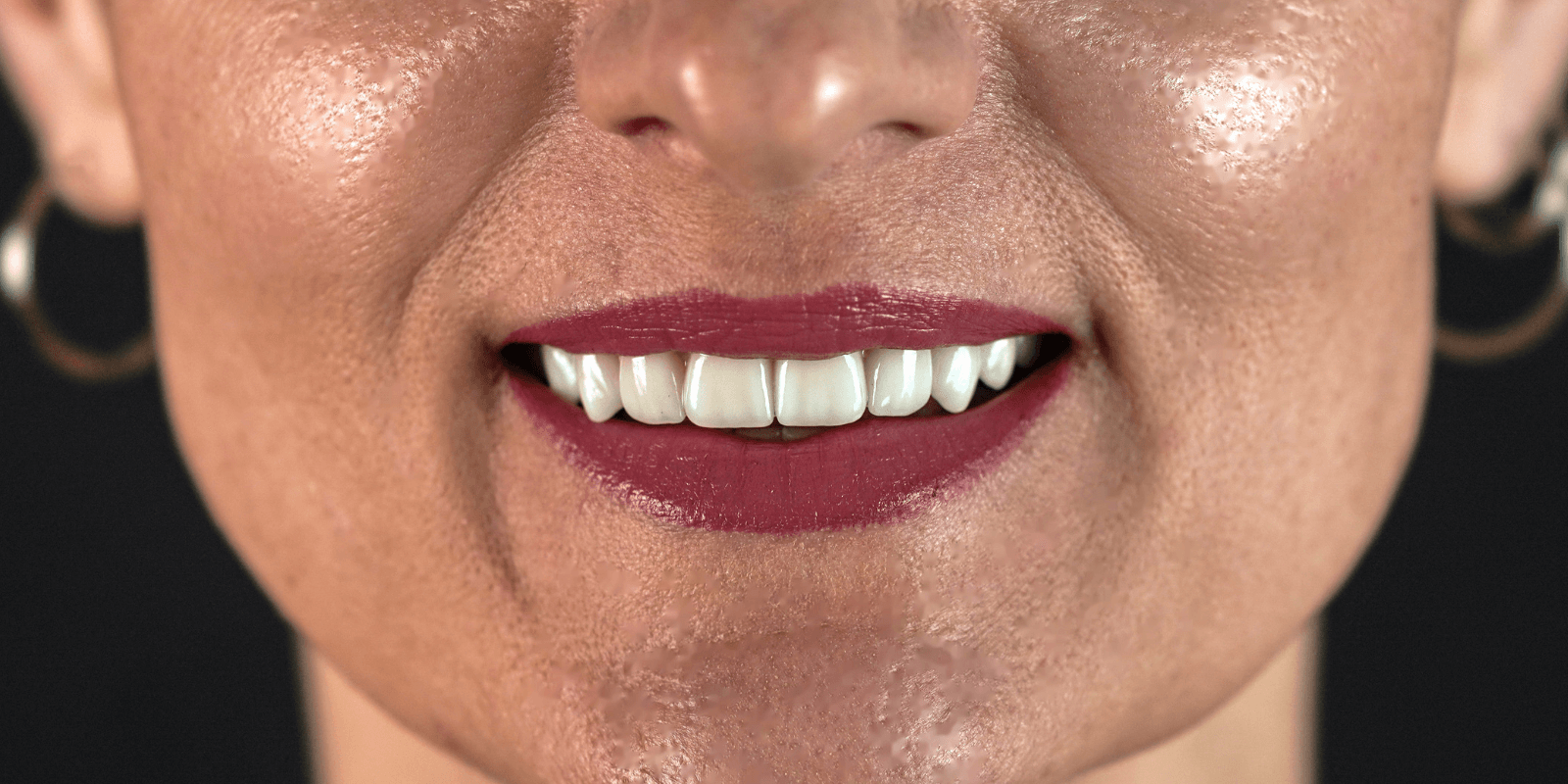 Імпланти Nobel та коронки e.max - неперевершений результат