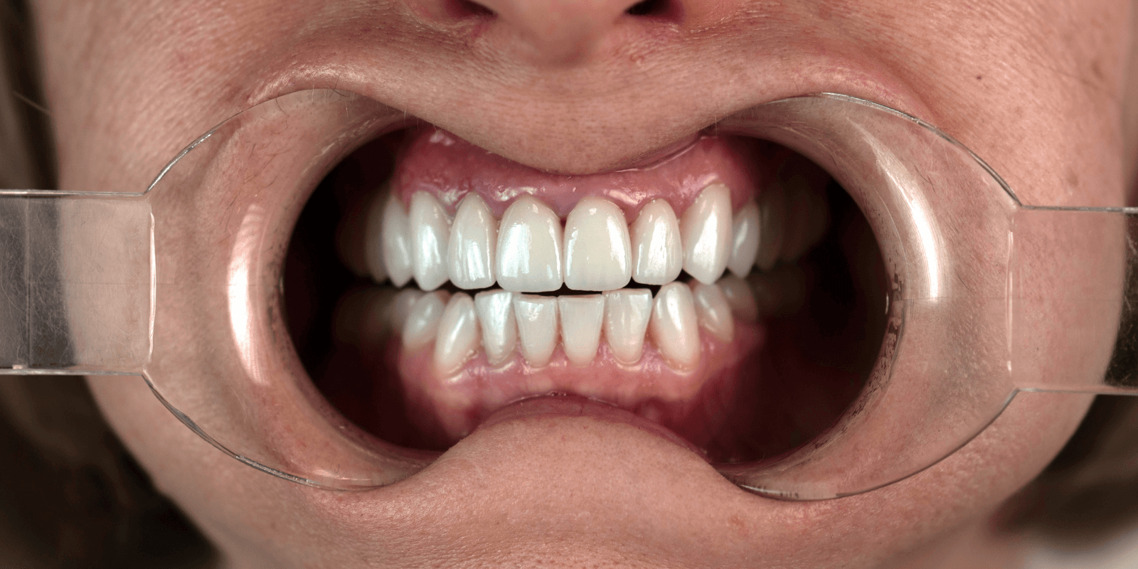 Імплантація Straumann та протезування цирконієвими коронками