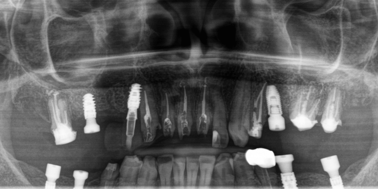 Імплантація Straumann та протезування цирконієвими коронками