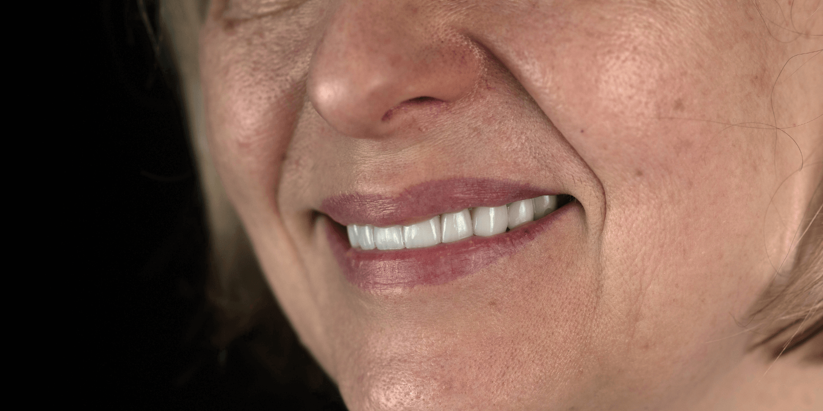 Імплантація Straumann та протезування цирконієвими коронками