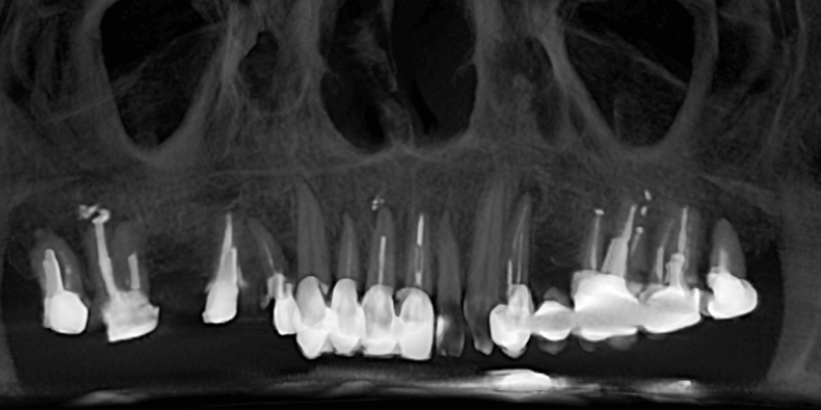Імплантація Straumann та протезування цирконієвими коронками