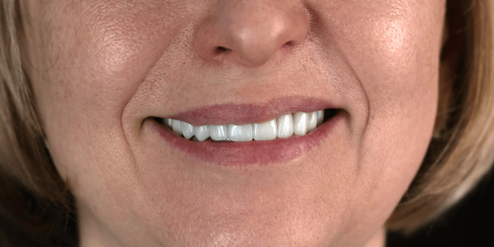 Імплантація Straumann та протезування цирконієвими коронками