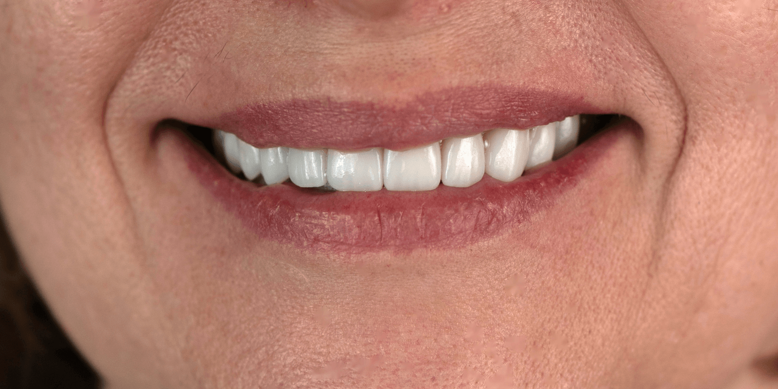 Імплантація Straumann та протезування цирконієвими коронками