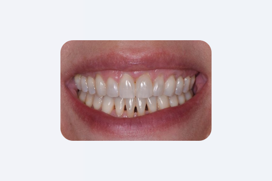 7 ознак старіння зубів, як перевірити і що робити